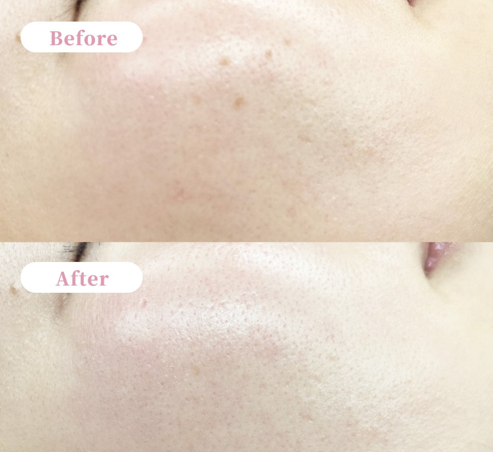 シミ集中ケアのビフォーアフター