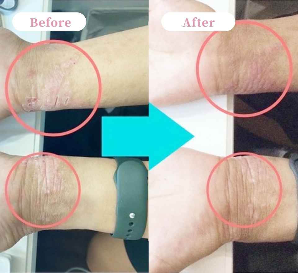 ニキビ・アトピーケアのビフォーアフター